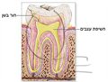 כיצד נוצר חור בשן?